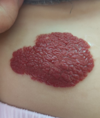 血管瘤和鲜红斑痣区别在哪？