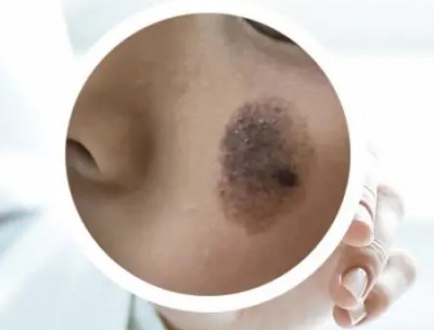 太田痣是怎么产生的？